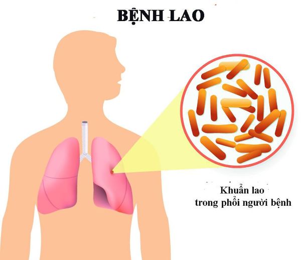 Bệnh lao phổi là gì